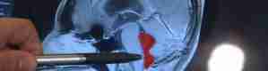 دودة في دماغ رجل لمدة 10 سنوات.. كيف دخلت وماذا فعلت بدماغه؟