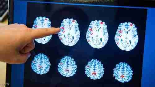 دماغ الرجل أم المرأة.. دراسة تكشف "الفارق المذهل"