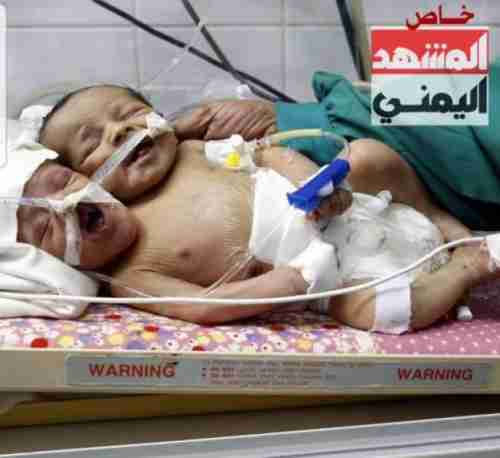 ولادة طفل يمني براسين في صنعاء .. صورة 