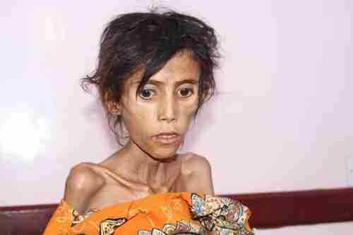 صورة ..شاهد  الفتاة التي توفيت من الجوع في حجة اليمنية 