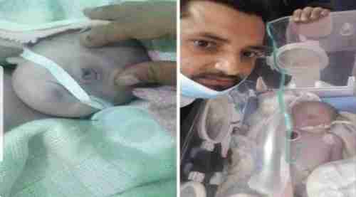 شاهد بالصور.. ولادة طفل بعين واحدة لأول مرة في اليمن 