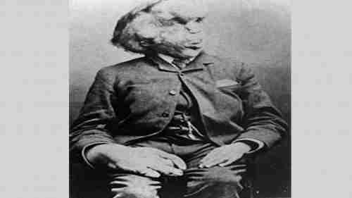 130 عاما على رحيل "الرجل الفيل".. جوزيف ميريك.. قصة عذاب ومعاناة