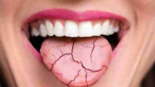 جفاف الفم قد يكون عارضا منذرا بخمسة أمراض خطيرة
