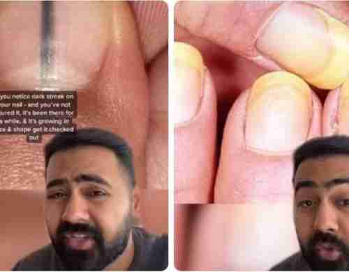 شاهد: طبيب بريطاني يكشف عن بقع تظهر في أظافر الأصبع تدل على الإصابة بالسرطان !