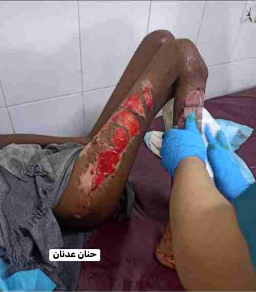 مريض في عدن جسمه يتآكل بسبب الفيروس وعلاجيه يحتاج ملايين 