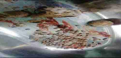 بالصورة: استخراج 177 حصوة من كليتي مريض يمني في صنعاء