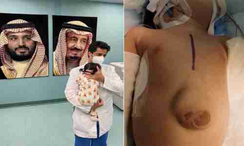 فريق طبي سعودي ينجح في إعادة قلب طفلة إلى قفصها الصدري