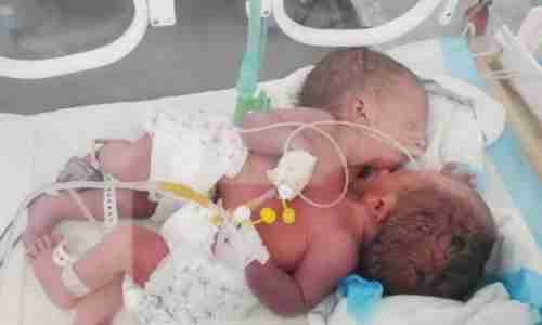 مستشفى حكومي بصنعاء يشهد ثاني ولادة نادرة