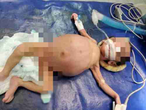 العثور على طفل في بطن شقيقته حديثة الولادة بحضرموت