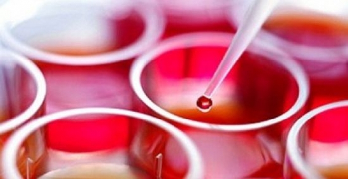 استخدام خلايا جذعية لمعالجة مصابة بقصور القلب في فرنسا