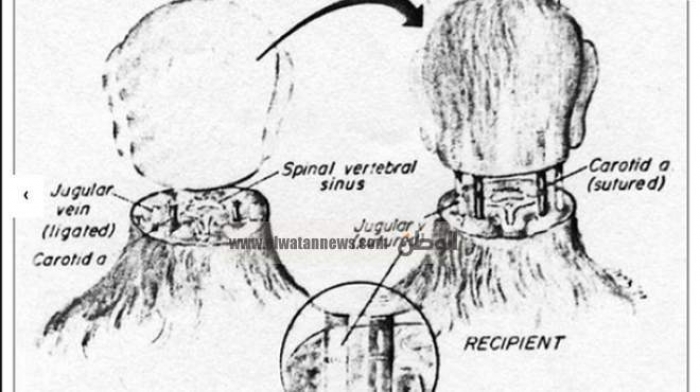 لأول مرة.. إجراء عملية لزرع رأس إنسان على جسد شخص آخر