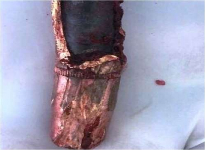 استخراج رصاصة حوثية من صدر شاب يمني (صورة)