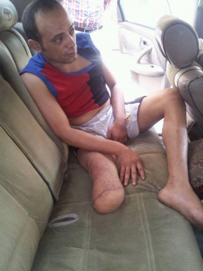 بالصور .. تعرض لغرغرينا وبترت ساقه : لاعب طليعة تعز مفيد الصالحي بحاجة لدعم نفسي ومادي ..