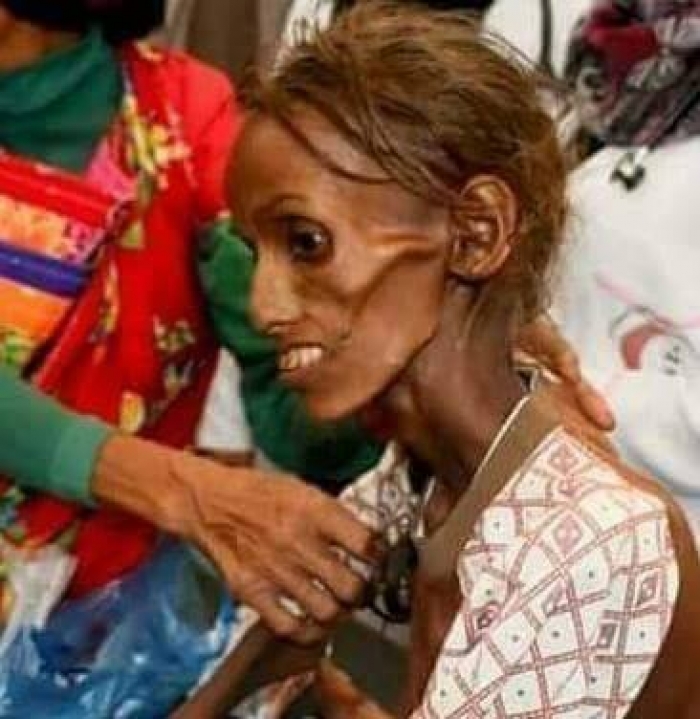 المجاعة تهدد اليمن ومناشدة أممية للعالم بتقديم الدعم