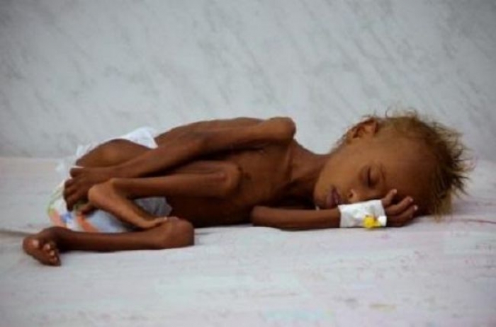 أكثر من مليون طفل يمني يعانون الجوع