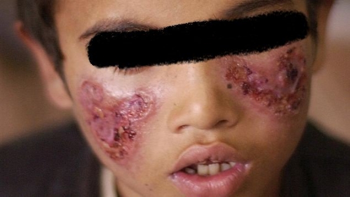 شاهد بالصور .. انتشار وباء جلدي خطير في تسع محافظات يمنية!!