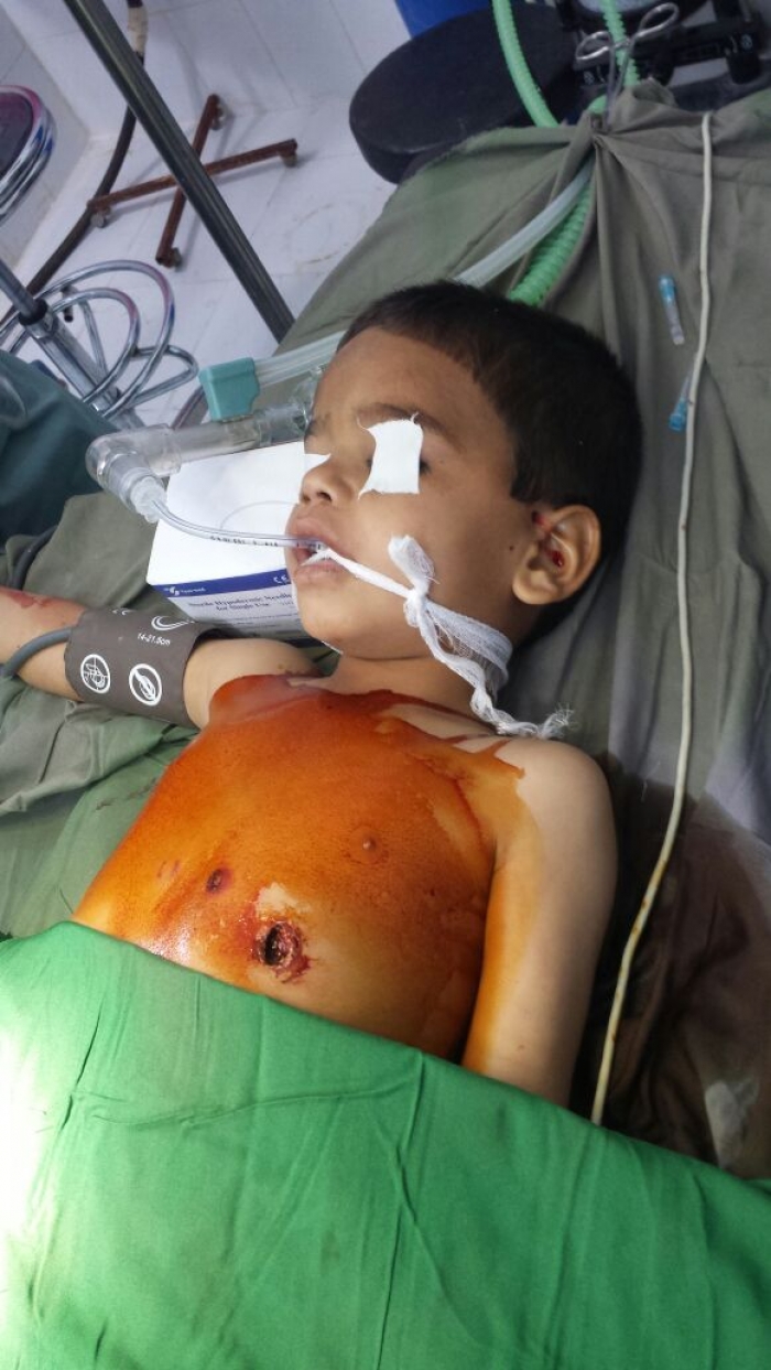 بالصور : لأول مرة إجراء عملية جراحية في القلب لطفل إثر انفجار ألغام زرعتها ميليشيا الحوثي واليوسفي يشيد بجهود الكادر الطبي