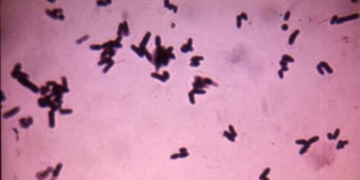 التحذير من تفشي وباء “الدفتيريا القاتل” بعد وفاة واصابة العشرات في إب وصنعاء