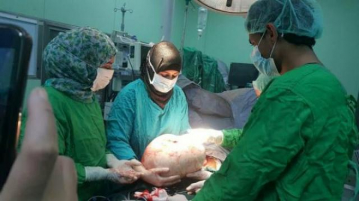 طبيبة يمنية في صنعاء تستئصل أكبر ورم سرطاني في العالم يزن 21.37 كيلو جرام