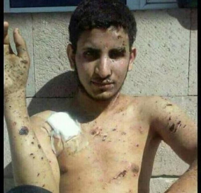 الضالع: آثار تعذيب وحشي تعرض له شاب في سجون الحوثي (صورة)