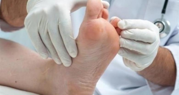 ما أسباب الإصابة بمسمار القدم .. وطرق علاجه؟