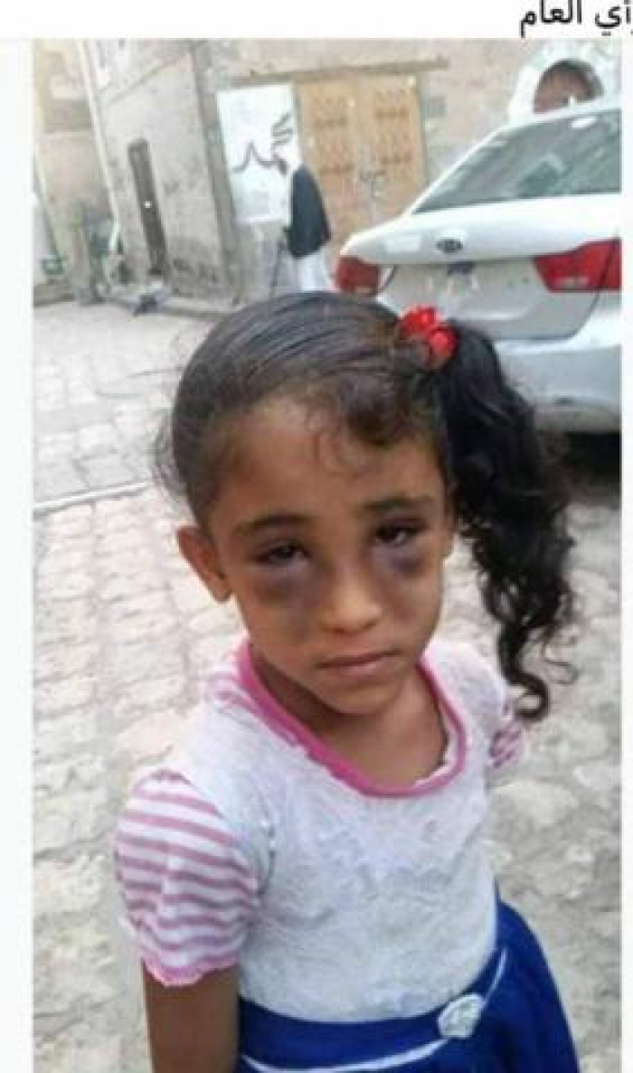صنعاء:طفلة عذبها والدها بوحشية واجهزة الأمن تقبض عليه (صورة)