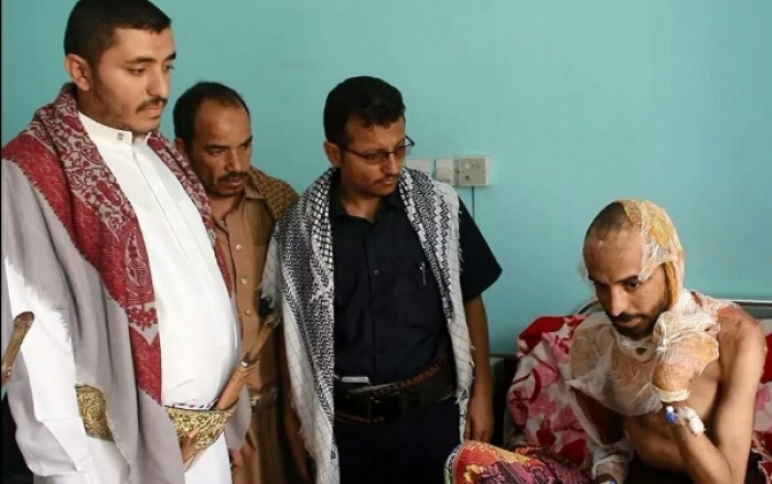 صوره هزت اليمن - طبيب متخصص يكشف عن المادة التي احرق بها الحوثيون جسد «الشرقي» ومراحل علاجه وفترة عزله اجتماعيا