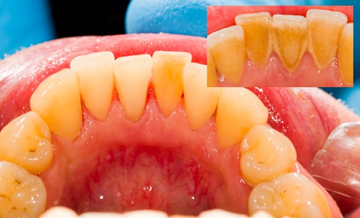 إزالة جير الأسنان ٢٤ طريقه نتائجها خلال ٣ أيام