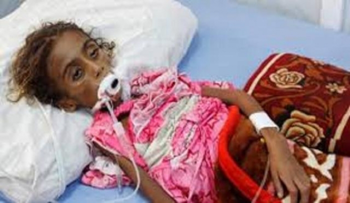 تقرير : سوء التغذية الحاد أدى إلى مقتل 85 ألف طفل يمني خلال 3 سنوات