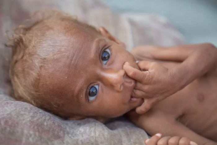 هل مات نصير؟ تقرير غربي يتساءل عن مصير طفل يمني كاد يموت جوعاً مرتين ولا يُعلم مكانه الآن