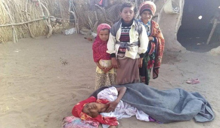 مأساة "نوف" بنت الـ3 أشهر.. سوء التغذية الوخيم يفتك بأطفال التحيتا